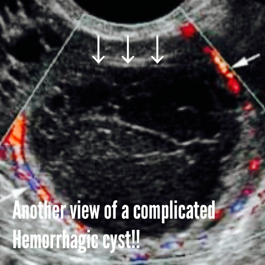 Hemorrhagic Cyst Cause Symptoms Complications Ultrasound