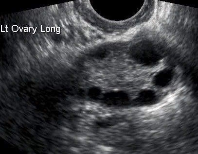 normal female anatomy, view of the ovary on ultrasound