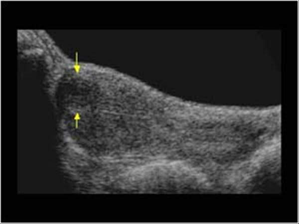 Anteverted uterus / Intramural fibroid / Transabdominal scan.