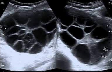 Ultrasound image of Theca lutein cysts.