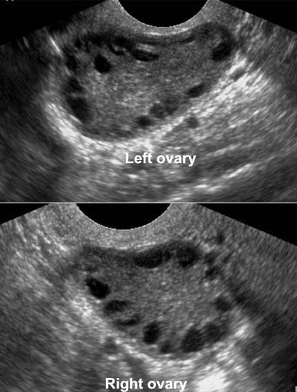 Ultrasound images of PCOS.