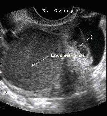 Endometrioma cyst.