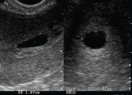 Ultrasound image of a gestational sac measuring 5 weeks 1 day.
