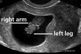 fetal pole seen on ultrasound 8 weeks