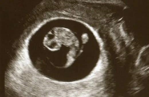 8 week fetal pole