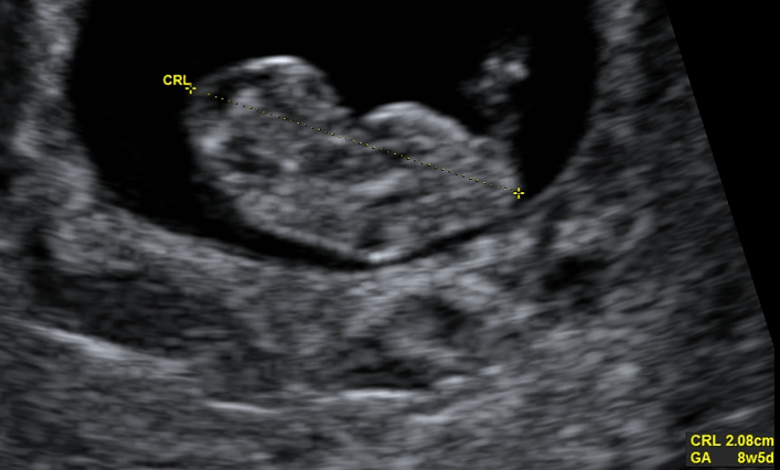 ultrasound image of a baby at 8 weeks