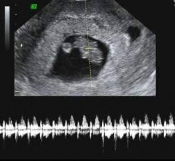 10 weeks baby ultrasound, HEART DOPPLER