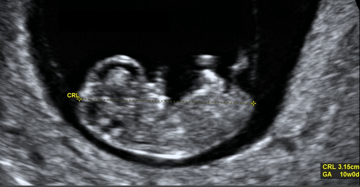 10 weeks baby ultrasound