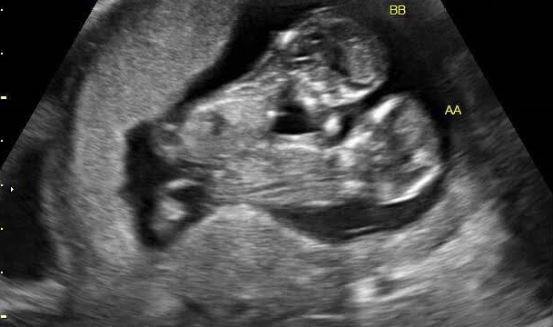 10 weeks baby ultrasound, TWINS