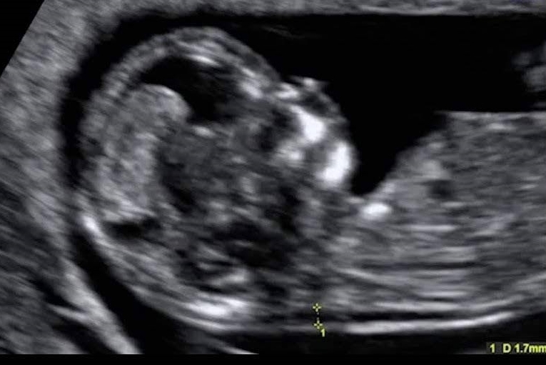 11 weeks baby ultrasound, NUCHAL TRANSLUCENCY