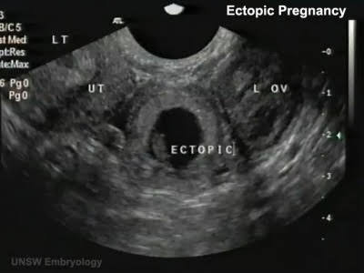 Ectopic pregnancy.