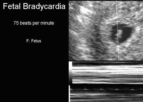 Fetal Bradycardia.