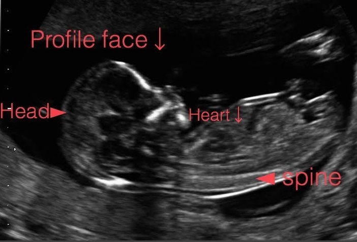 14 week ultrasound