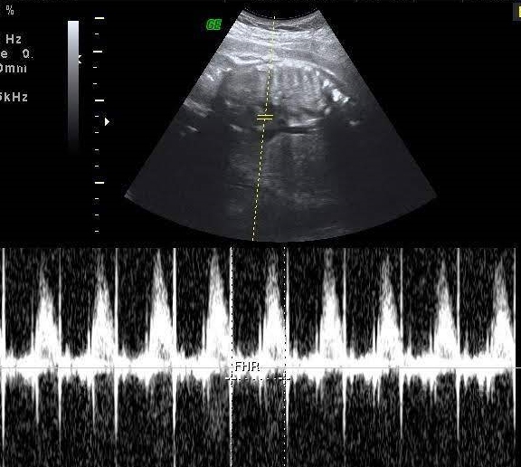 18 week fetal ultrasound doppler