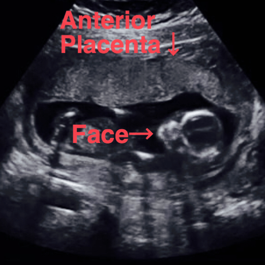 normal 15 week ultrasound