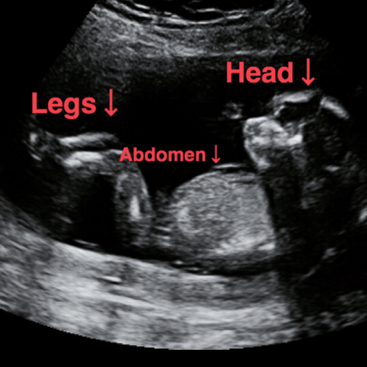 normal 15 week ultrasound