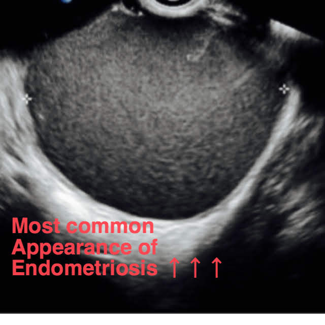 Endometrioma cyst seen on ultrasound.