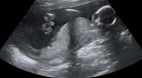 13 week posterior placenta