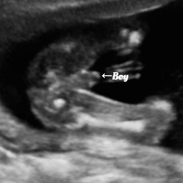 17 week baby ultrasound, boy gender