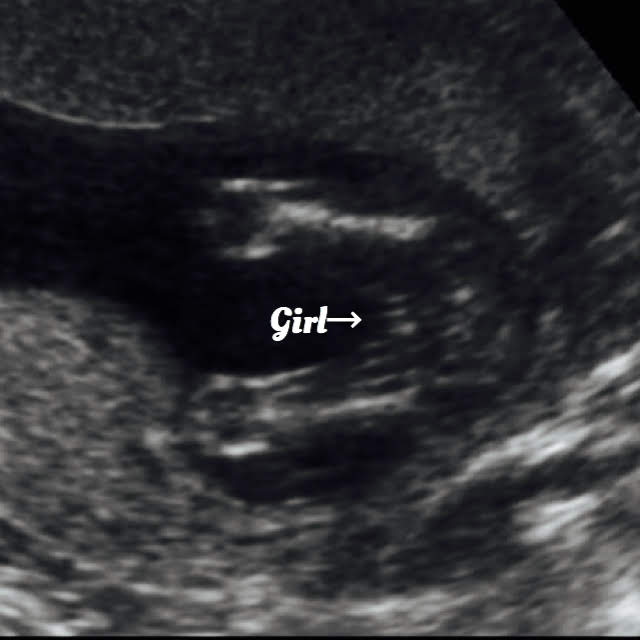 17 week baby ultrasound, girl gender