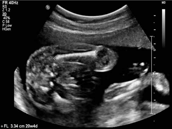17 week baby ultrasound