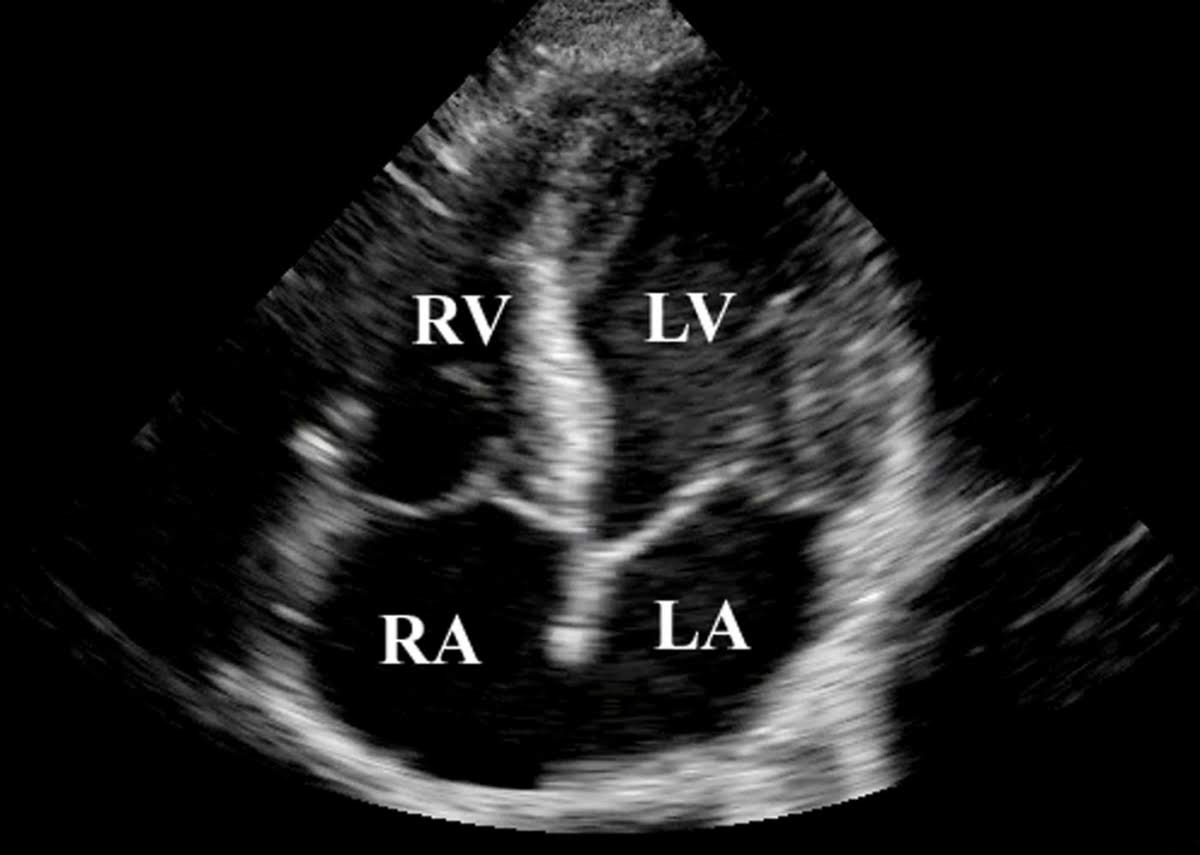 18 week fetal ultrasound heart