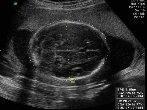 18 week fetal ultrasound