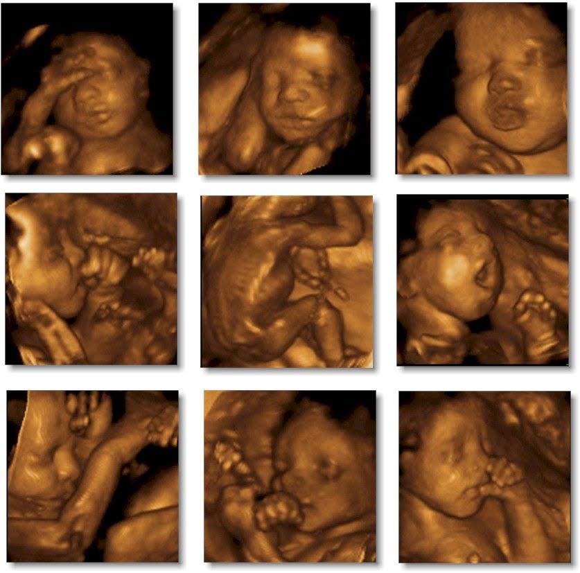 18 week fetal ultrasound 3d