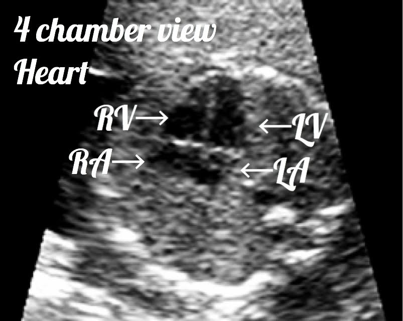 4 chamber of fetal heart seen on ultrasound