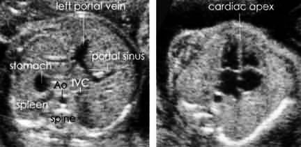 fetal abdomen and heart seen on ultrasound