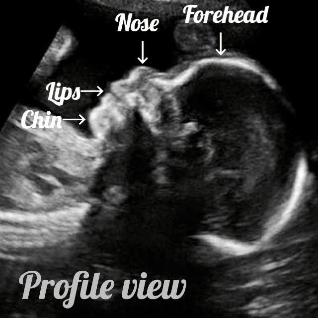 profile view of a baby on a ultrasound