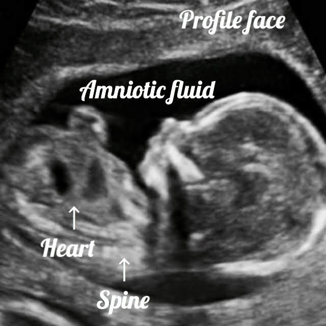 profile view of a baby on ultrasound, heart and spine are also seen