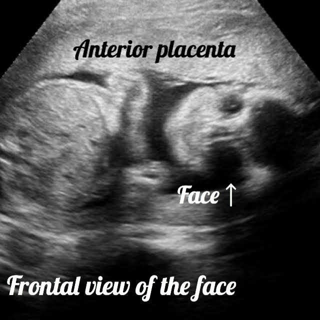ultrasound image of the face of a baby