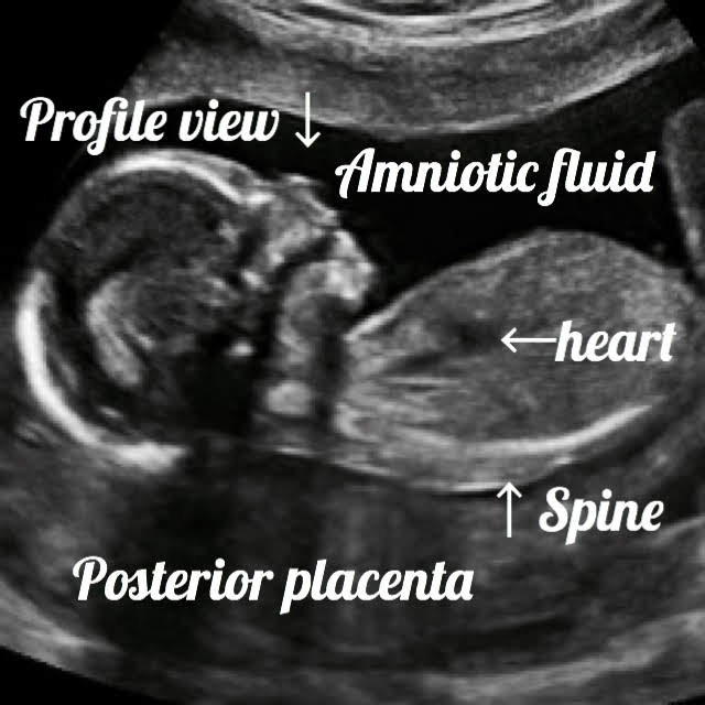 ultrasound image of a baby showing heart, spine, placenta and amniotic fluid