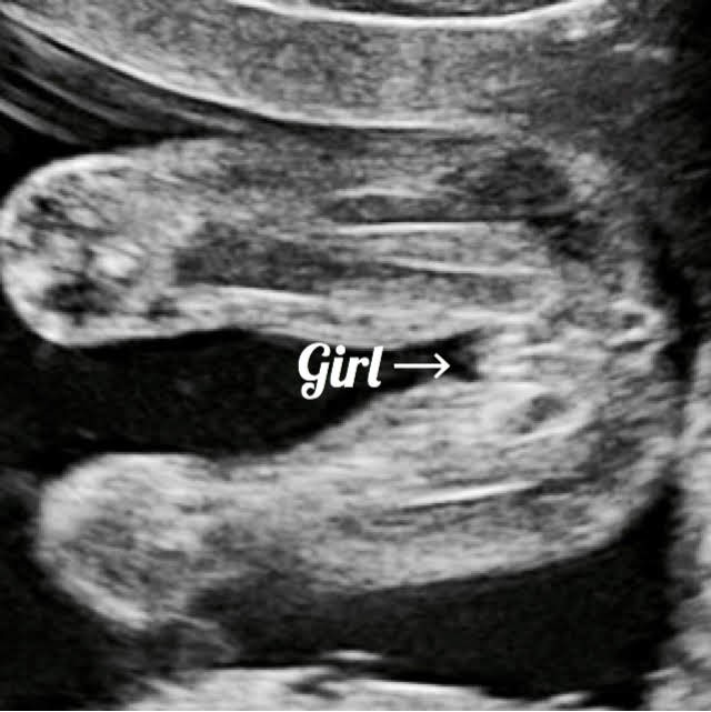 girl gender seen on ultrasound