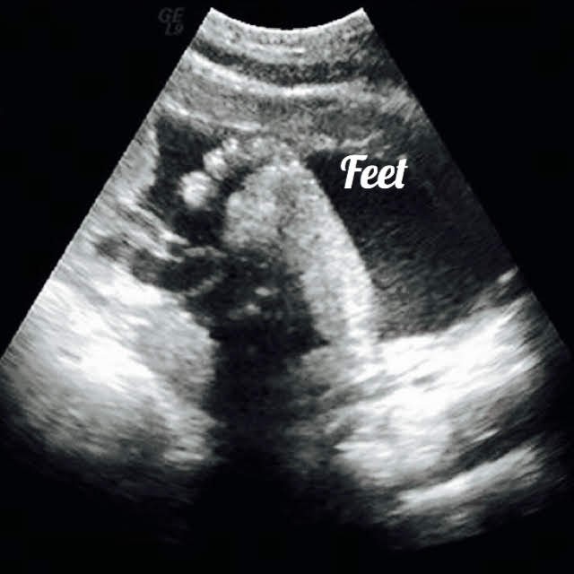 fetal feet seen on ultrasound