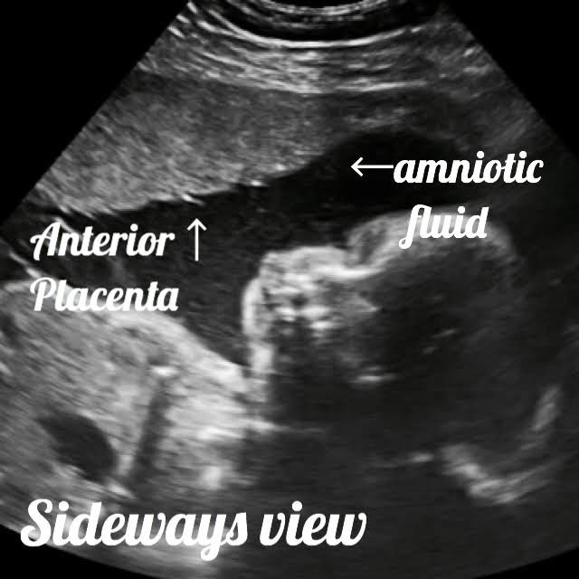 view of placenta and amniotic fluid