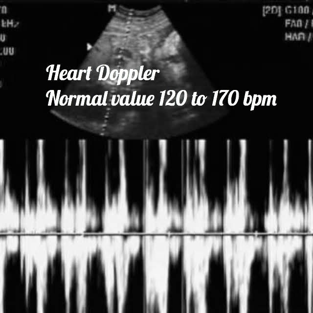 doppler of the heart