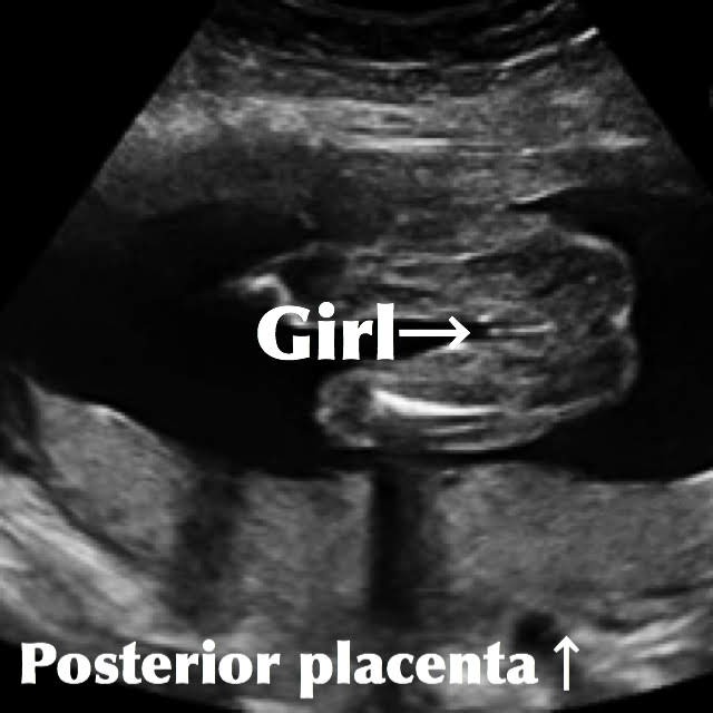 girl genitalia seen on ultrasound