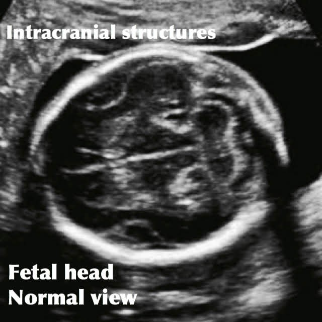 intracranial structures seen on ultrasound/ fetal head