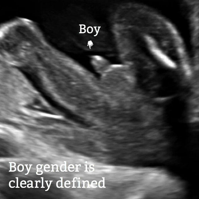 boy gender seen on ultrasound/ Normal 29-week pregnancy
