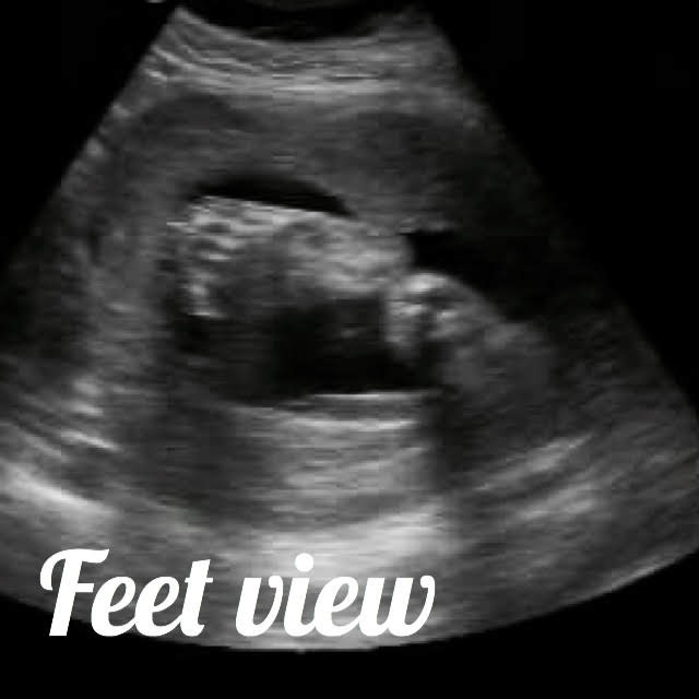 ultrasound feet view