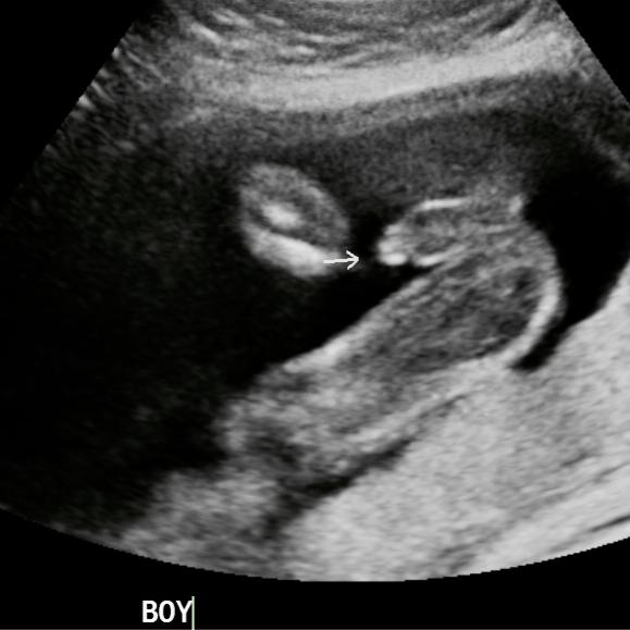 boy genitalia seen on ultrasound