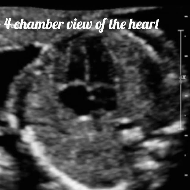 view of 4 chambers of fetal heart, as seen on ultrasound