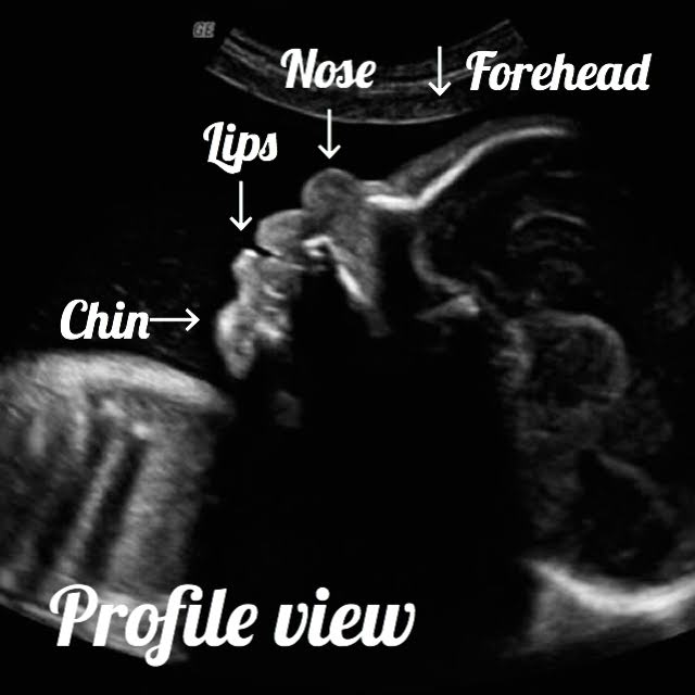 profile image of baby on ultrasound/ Normal 29-week pregnancy
