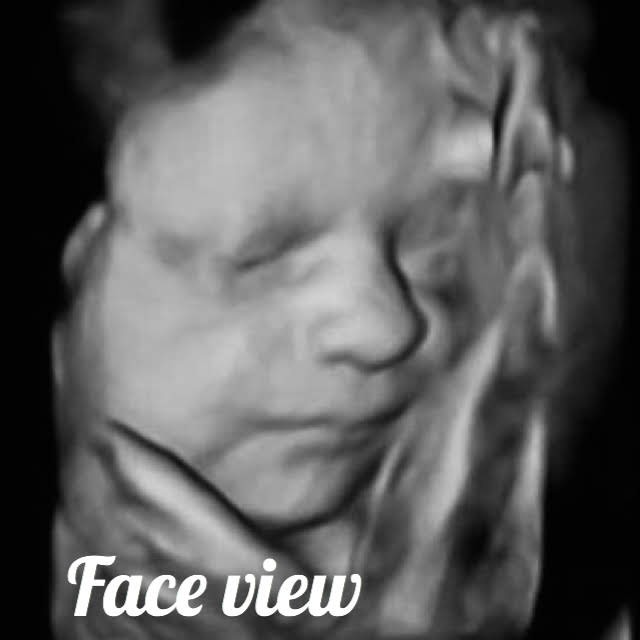 fetal face seen on ultrasound
