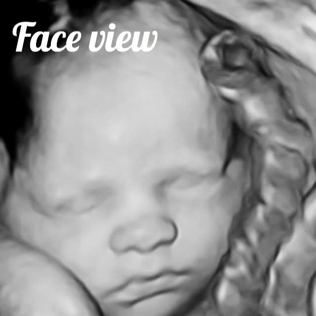 fetal face seen on ultrasound