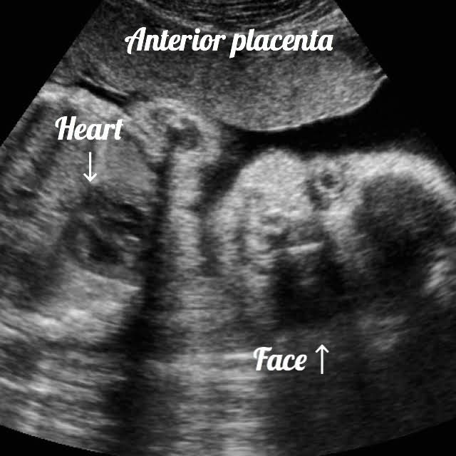 frontal view of a baby seen on ultrasound