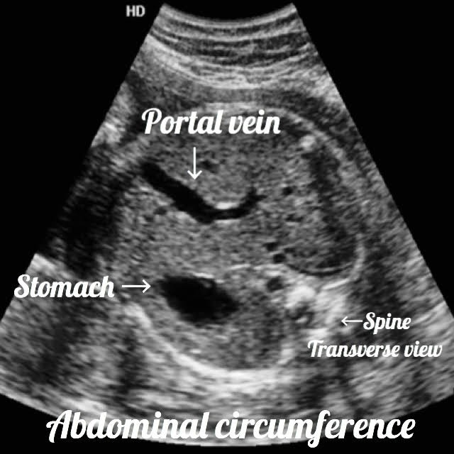 transversal view of a fetal abdomen, seen on ultrasound