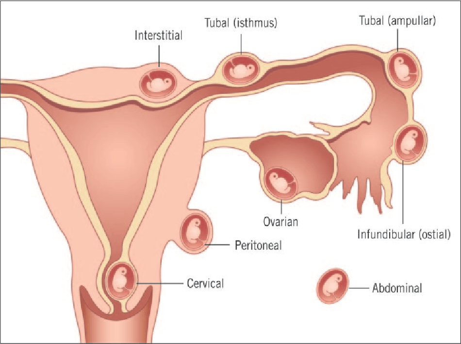 all the different locations where an ectopic pregnancy can be found